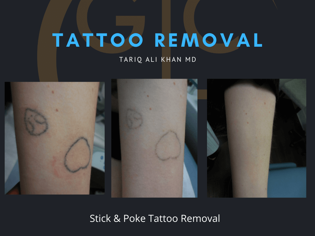 Gentle Care Laser Tustin & Long Beach CA Before and After picture - Tattoo Removal